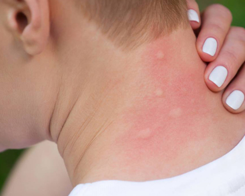 Tedderfield mosquito bites.w The itch of a mosquito bite is caused by the saliva that a female mosquito injects when she is drinking blood. This mild allergic reaction is what causes the itch which can last up to one week. The best way to relieve itch is to use an antihistamine cream or pill. Consult your doctor if your bites are particularly bothersome or if they appear infected.